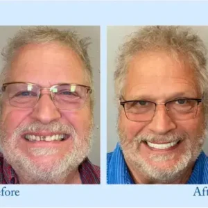 Smileasego™ – Premium Denture