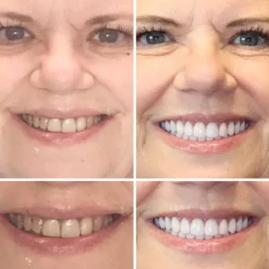 HZA™ Made in Germany Advanced Customized Full Denture Set