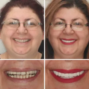 HZA™ Made in Germany Advanced Customized Full Denture Set