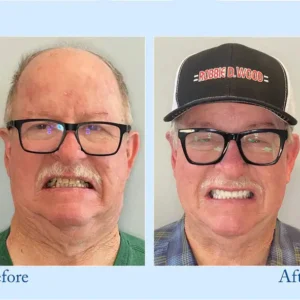 Smileasego - Premium Denture