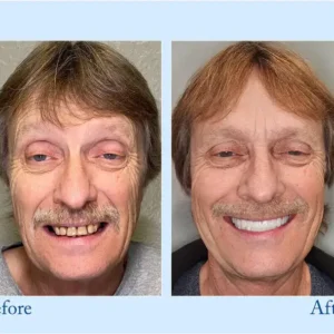 Smileasego - Premium Denture