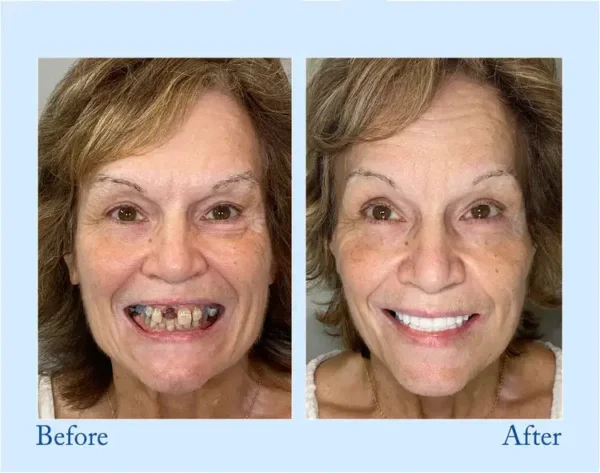 Smileasego - Premium Denture