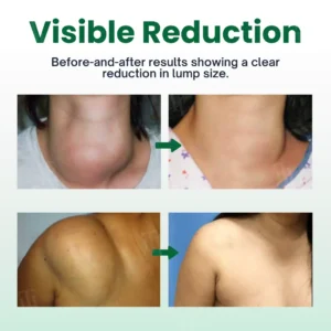 🏷️ EXCLUSIVE DEAL! 50% OFF - Cvreoz® Knot-X Lipoma Dissolve Cream