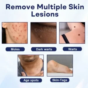 Cvreoz® Mole and Wart Removal Cream