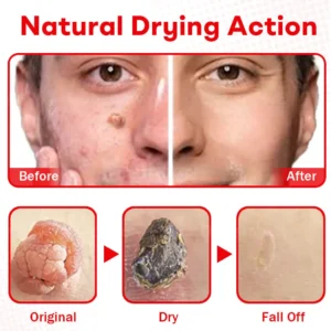 Cvreoz®MicroNeedle BotanicSkin Tag Removal Patch