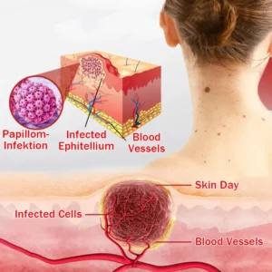 Cvreoz®MicroNeedle BotanicSkin Tag Removal Patch