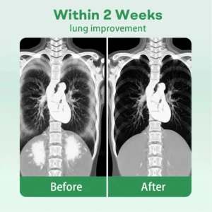 ✅Official Store| Cvreoz® Herbal Lung Cleansing Inhaier(🫁Cough, wheezing, shortness of breath, sputum, stuffy nose, bronchitis, bronchitis, allergy symptoms, lung discomfort💝)